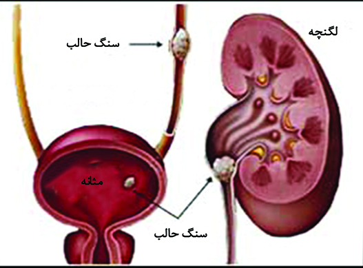 سنگ ادراری